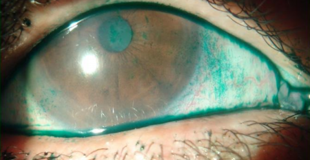 Cornea – Superficie Ocular / Cortesía Dr. MartÍn Berra
