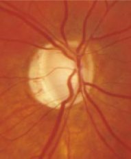 Glaucoma- Cortesía Dr Héctor Fontana